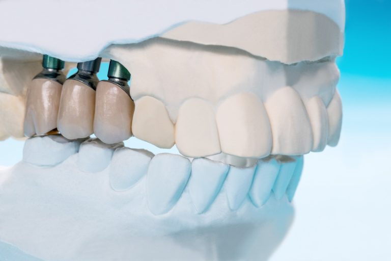 Dental model showing three implant supported crowns integrated into the upper jaw used to replace missing teeth
